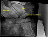 Xray showing damage of cable snare