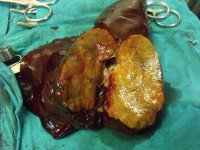 Cut section through liver tumour of pangolin